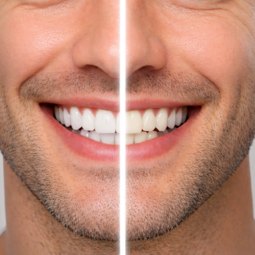 Illustration of teeth whitening